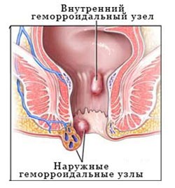 Жизнь без геморроя