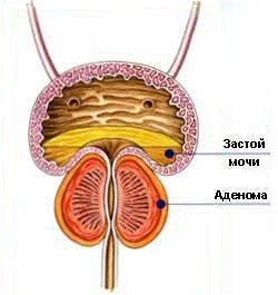 Предстательная железа - второе сердце мужчины