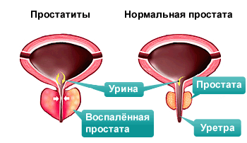 Симптомы простатита